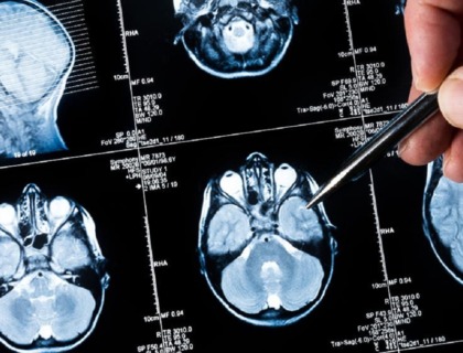 imagen de un TAC de una persona con atrofia cerebral.