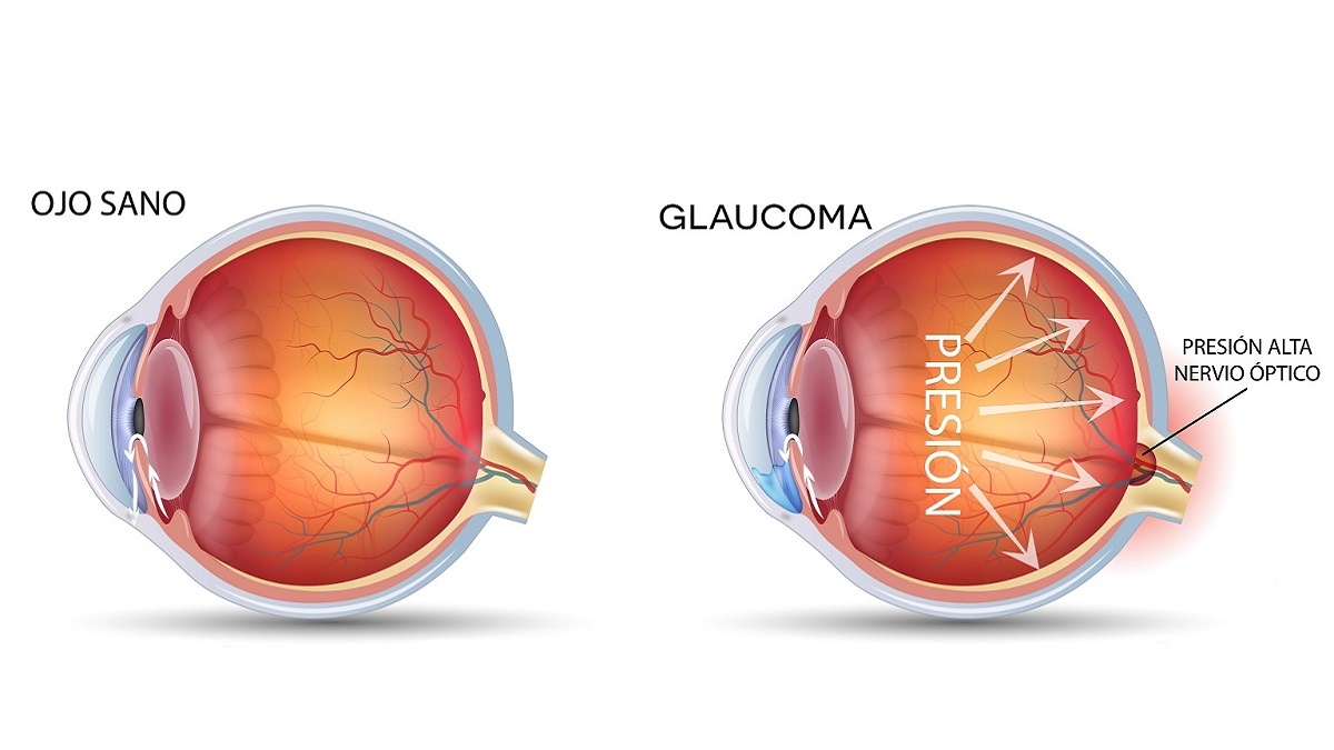 causas de la ceguera: imagen de la comparación de un ojo sano con otro con glaucoma