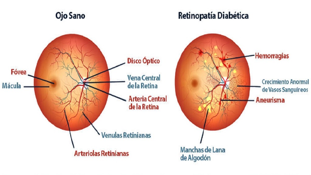 causas de la ceguera: imagen de la comparación de un ojo sano con otro con retinopatía diabética