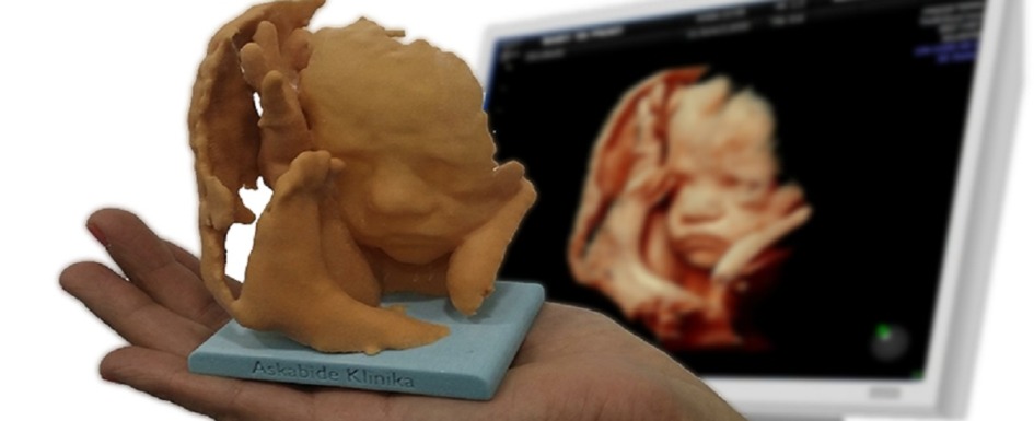 imagen 3d: imagen de una ecografía y la impresión 3d de la misma