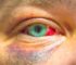 accidentes oculares: imagen de un ojo dañado