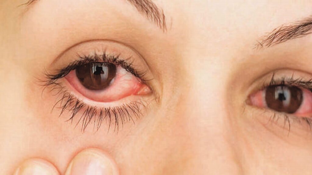 alergias oculares: imagen de una mujer con los ojos irritados