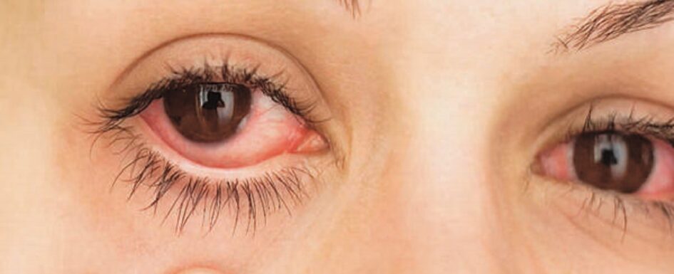 alergias oculares: imagen de una mujer con los ojos irritados