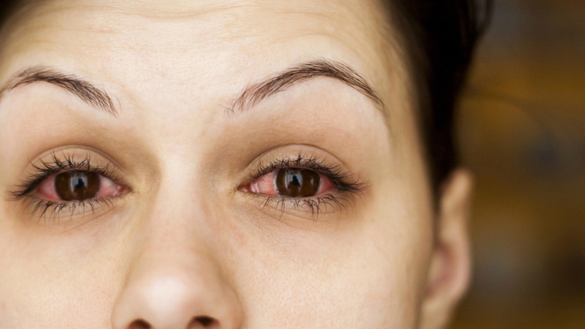 alergias oculares: imagen de una mujer con los ojos irritados