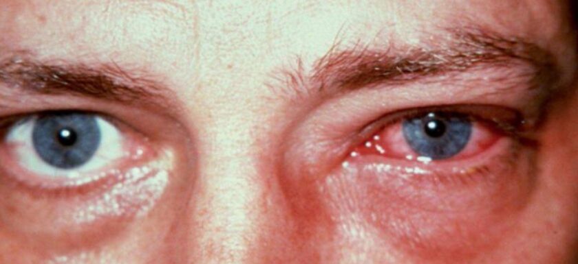 alergias oculares: imagen de un hombre con los ojos irritados