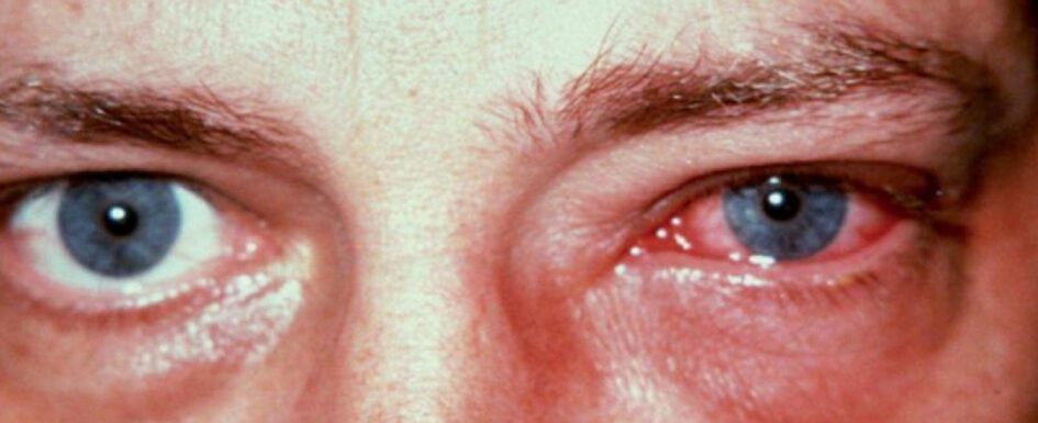 alergias oculares: imagen de un hombre con los ojos irritados