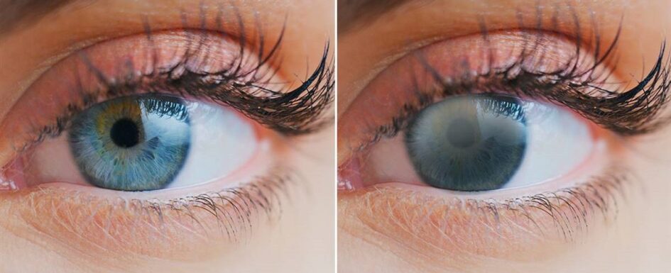 imagen de una persona con cataratas