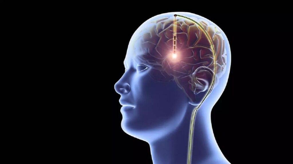 Simulación de estimulación cerebral gracias a implantes cerebrales