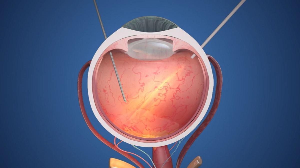 animación que muestra cómo se implanta quirúrgicamente el implante ocular prima